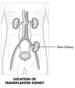 Kidney%20Failure%20-%20Treatment%20Options08.jpg